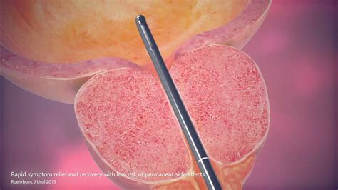 UroLift® System Procedure Animation .